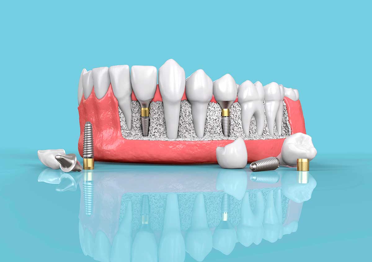 Full Mouth Dental Implants in Maryville TN Area