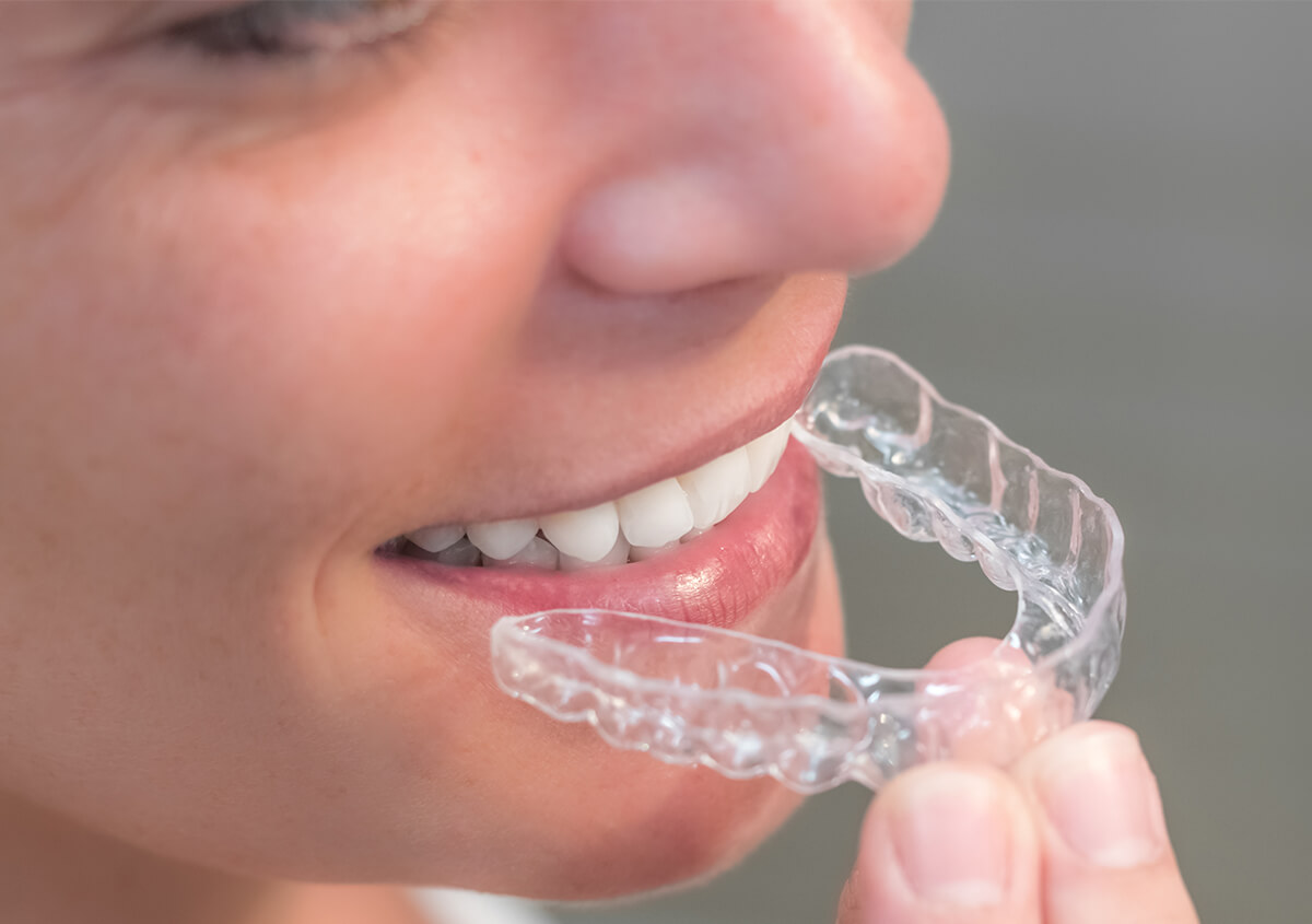 Invisible Aligners for Teeth Maryville TN