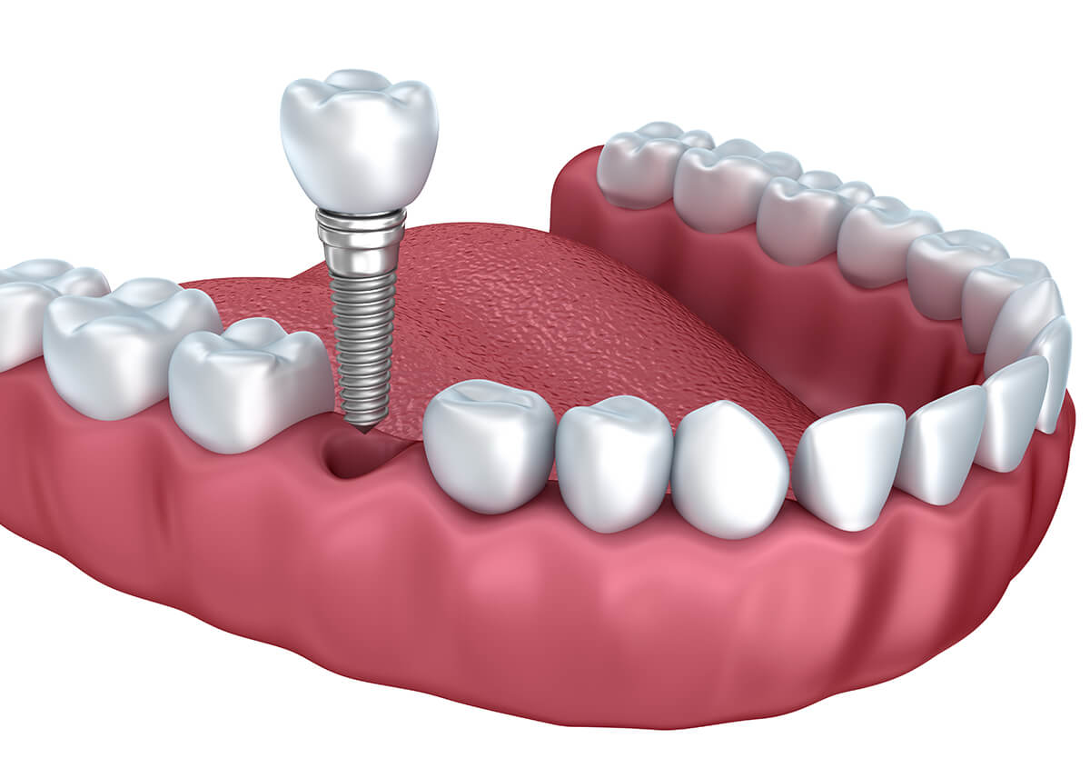 Dental Implant Restorations in Maryville TN Area