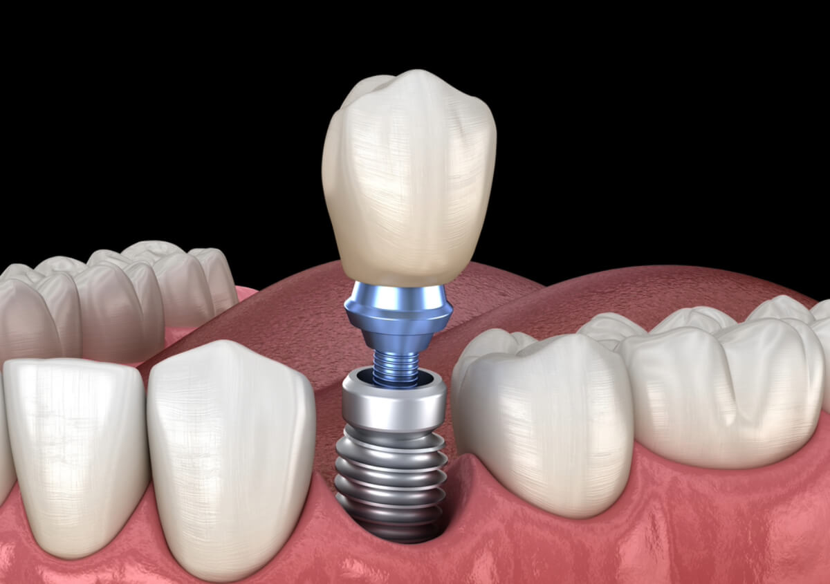 Dental Implants For Seniors in Maryville TN area