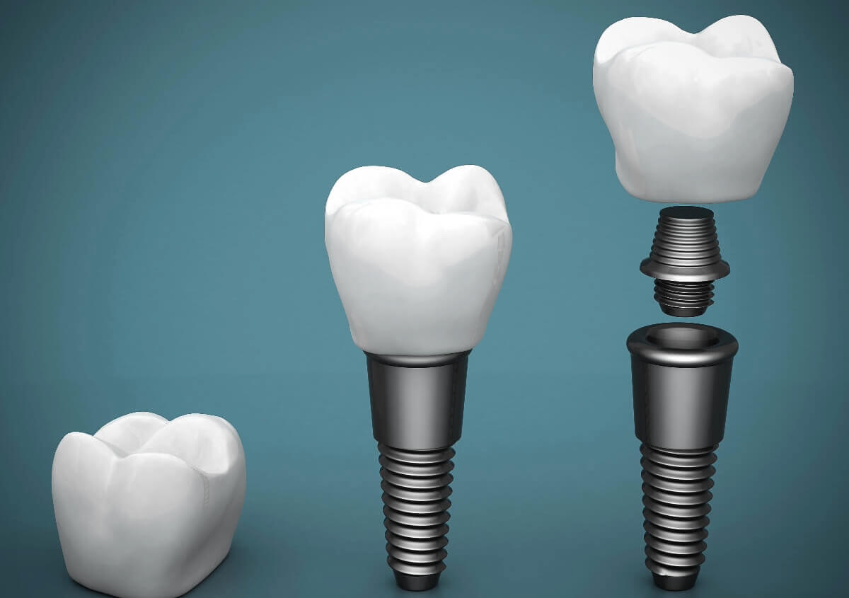 Dental Implants Process in Maryville TN area