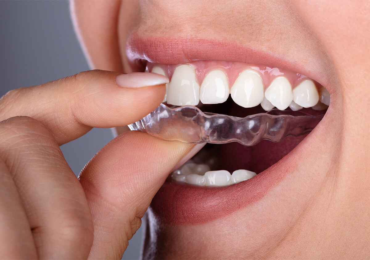 Invisalign Clear Aligners in Maryville TN Area